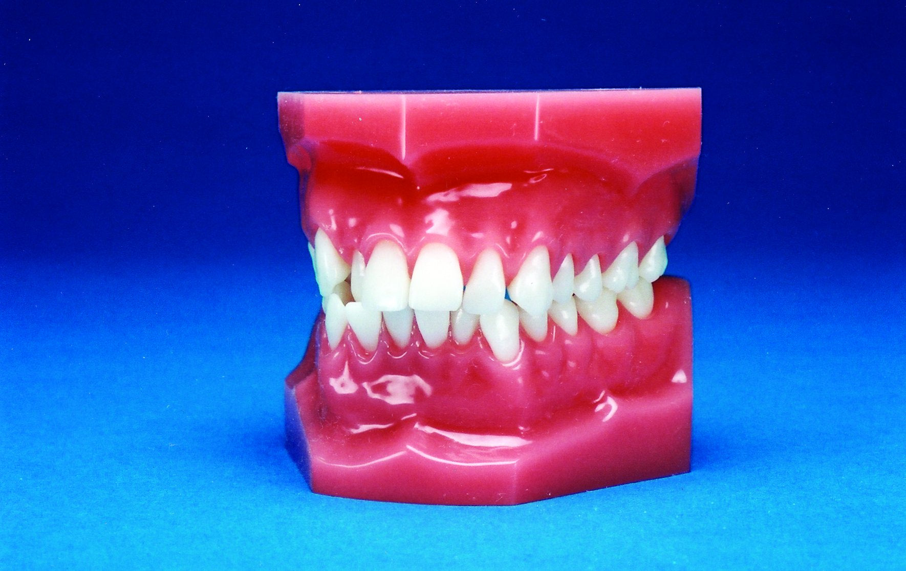 Malocclusion Series (Solid) Class I Crowded