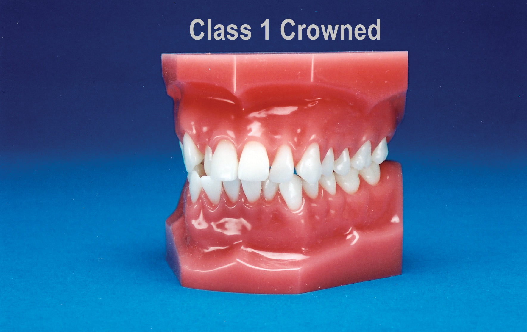 Malocclusion Series (Solid) Class I Crowded