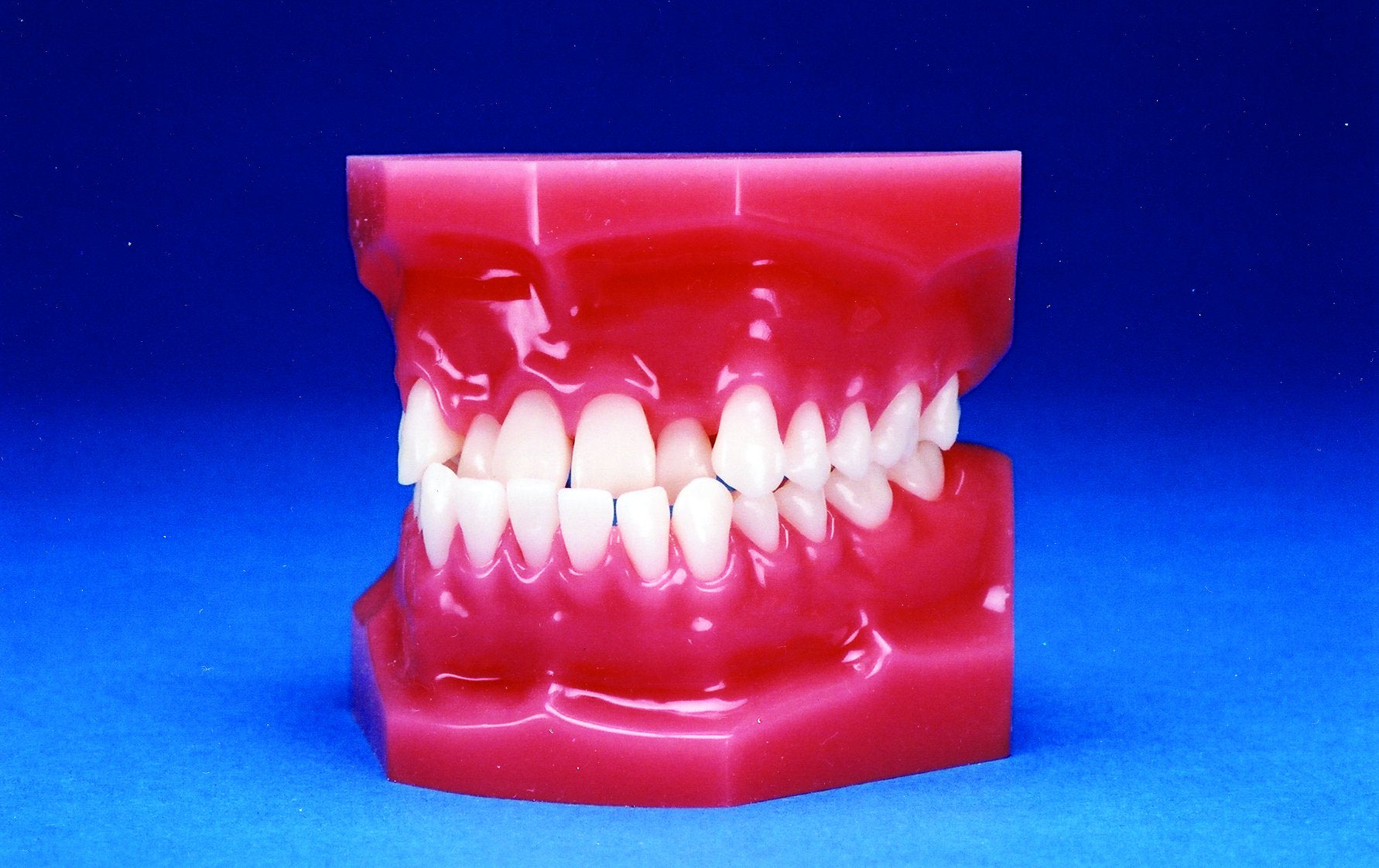 Malocclusion Series (Solid) Class III