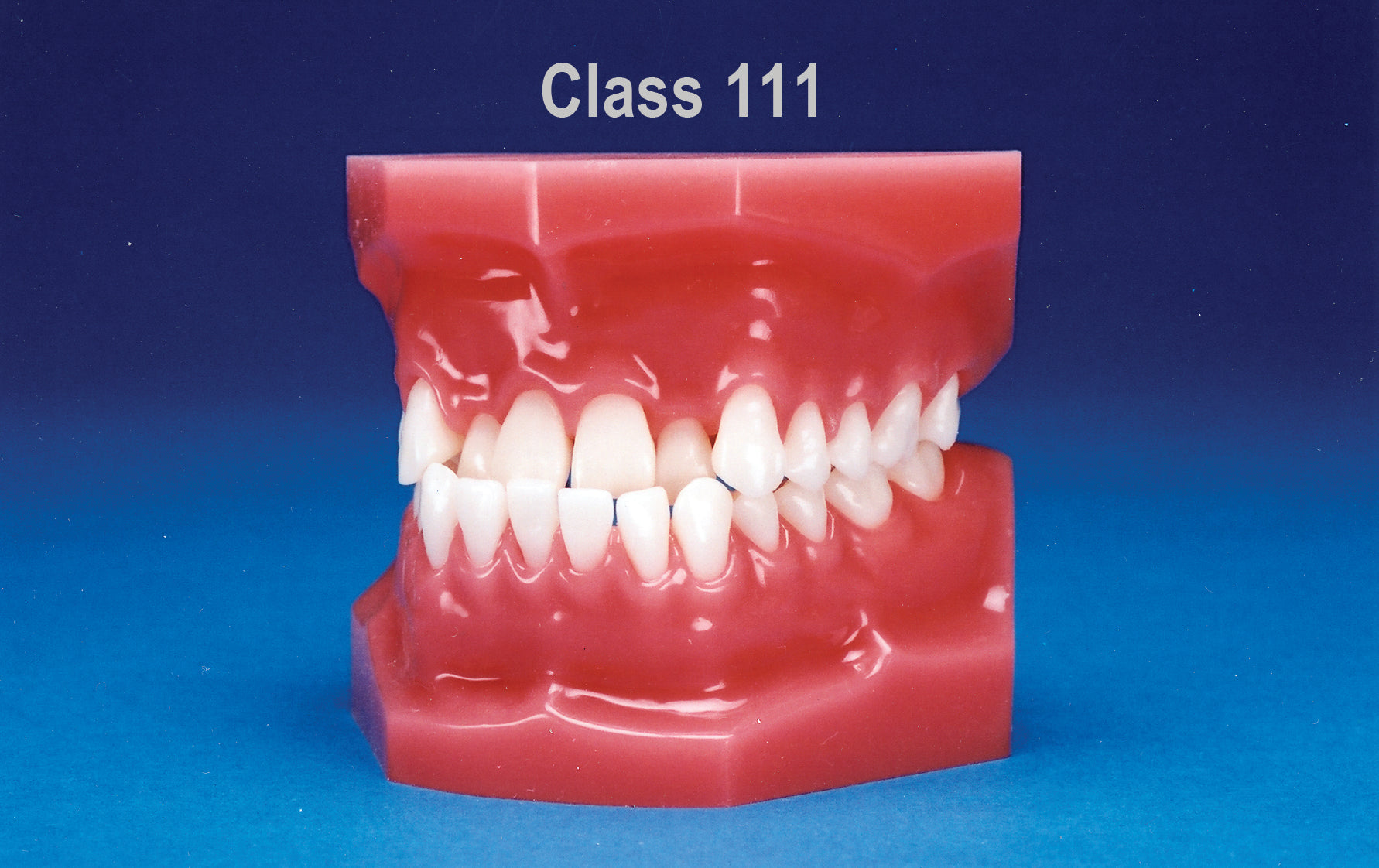 Malocclusion Series (Flexibase) Class III