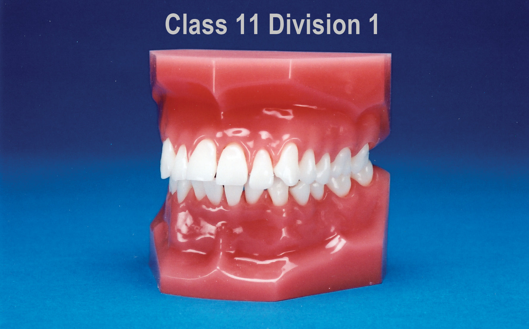 Malocclusion Series (Solid) Class II Division I