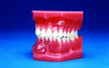 Malocclusion Series (Solid) Class II Division II