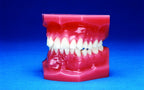 Malocclusion Series (Solid) Class II Division II