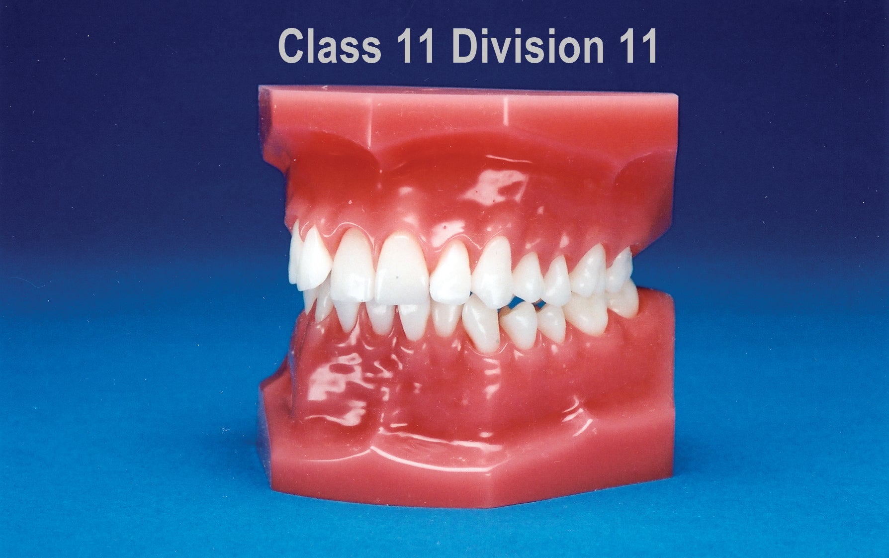 Malocclusion Series (Flexibase) Class II Division II